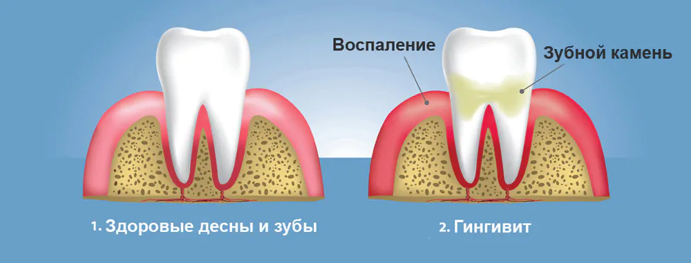 Осложнение после острого гингивита