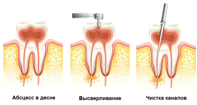 Терапевтическое лечение кисты зуба