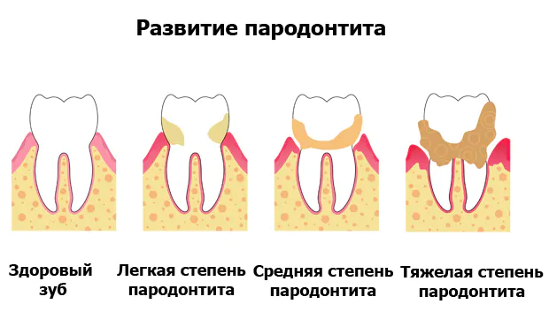 Пародонтит