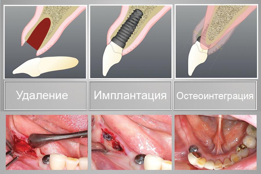 Одномоментная имплантация зубов с остеонтеграцией