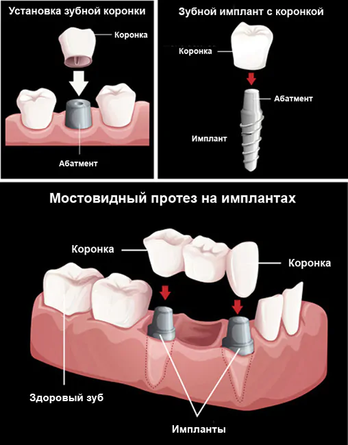 Двухэтапная дентальная имплантация