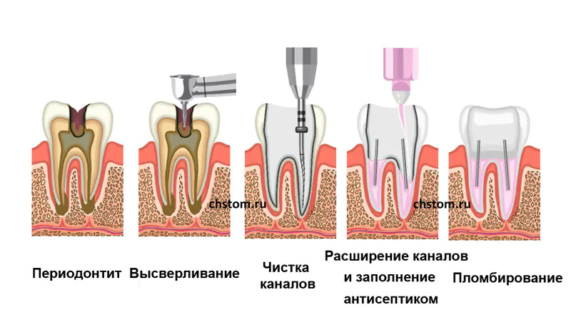 Лечение периодонтита