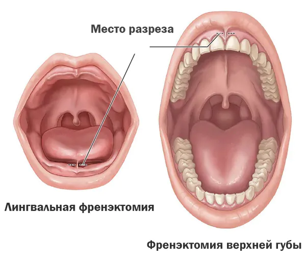 Френэктомия