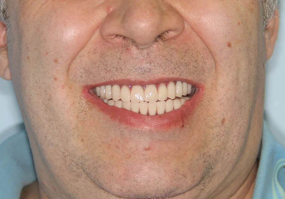 Зубы за 1 день