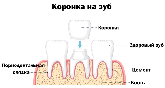 Керамическая коронка на зуб