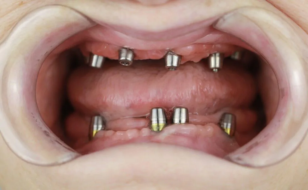 фото пациента с all-on-6 на верхней челюсти