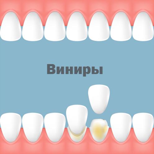 Виниры на нижние зубы
