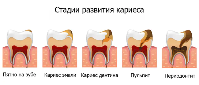 Стадии развития кариеса