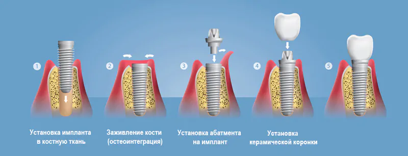 Этапы классической имплантации зуба