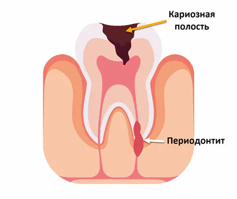 Периодонтит — симптомы и лечение