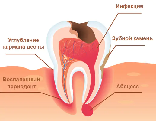 Лечение кисты зуба
