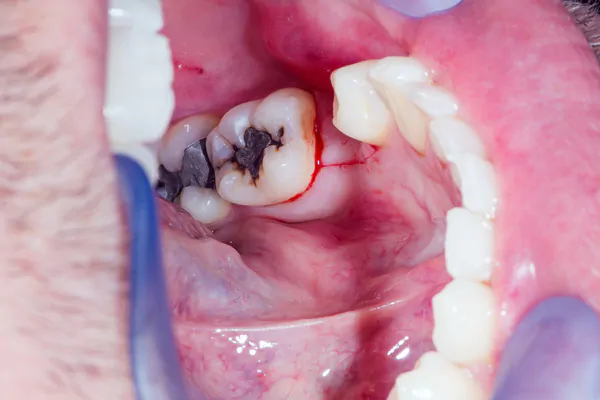 Кровоточивость десны при переодонтите запущенный случай с глубоким кариесом