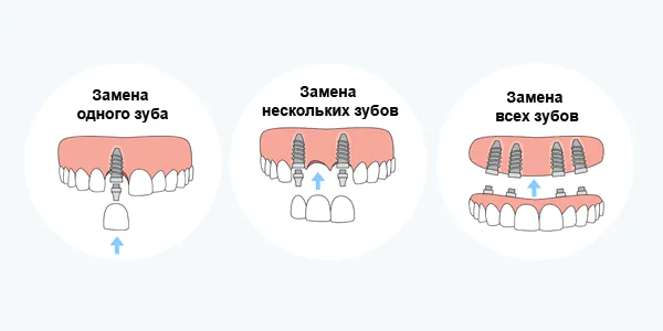 Виды имплантации зубов на верхней челюсти