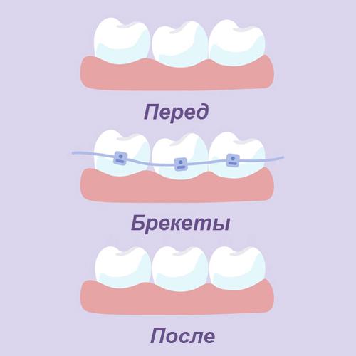 Исправление прикуса брекетами