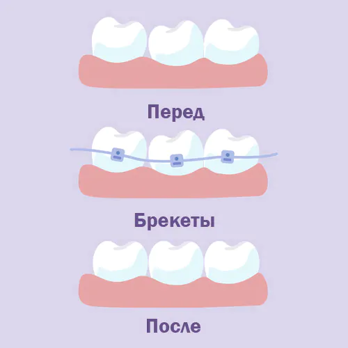 Перемещение зубов в правильное положение