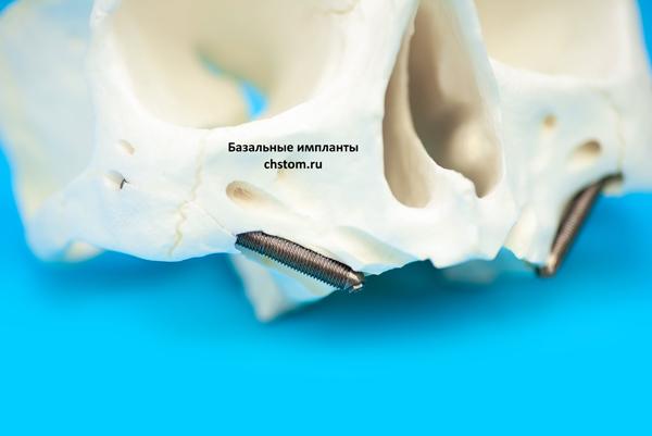 Скуловые имплантаты Zygoma от Nobel Biocare для имплантации ALL-on-4