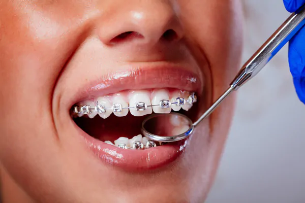 close-up-dentist-checking-braces-with-dental-mirror-female-patient