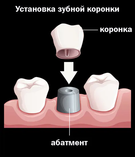 Установка коронок Noritake