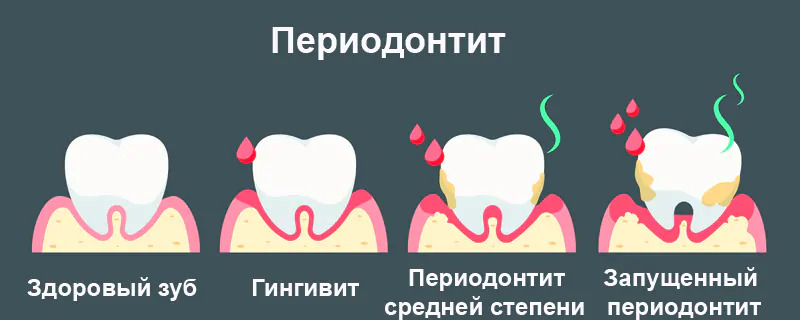 Стадии развития периодонтита