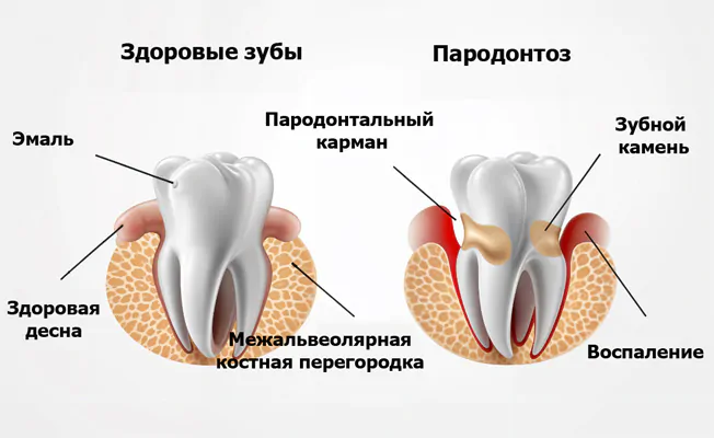 Симптомы пародонтоза