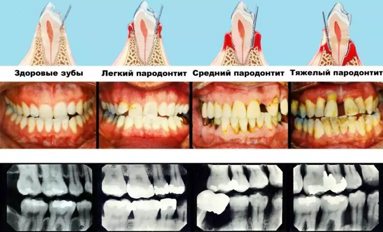 Что такое пародонтит?