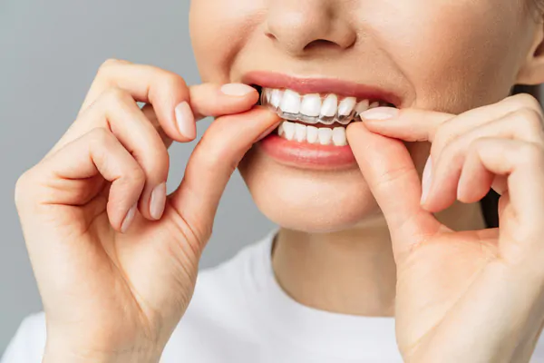 Элайнеры Invisalign