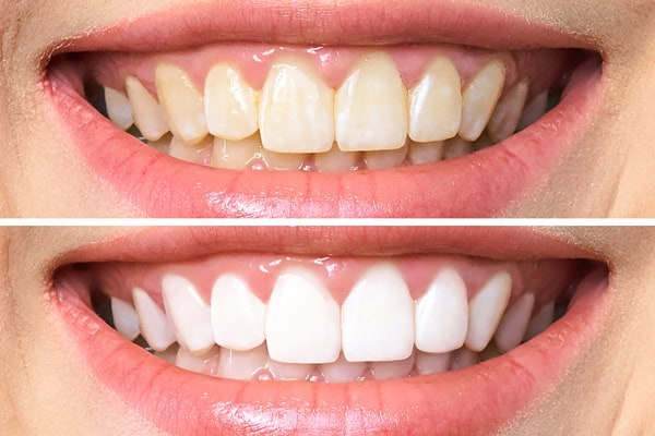 Zoom Whitening