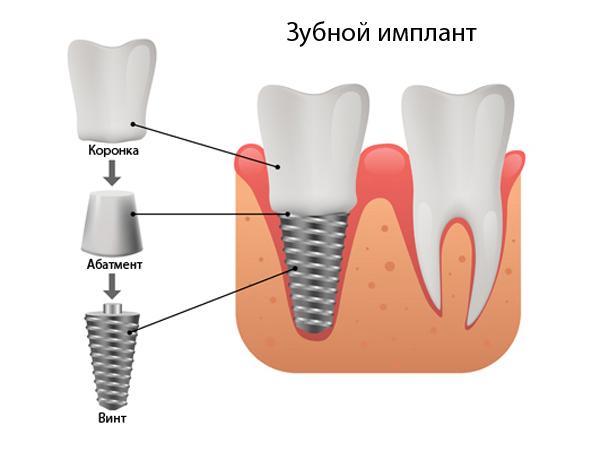 Дентальная имплантация