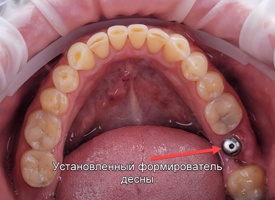 Формирователь десны