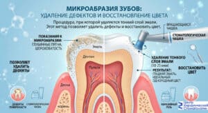 Микроабразия зуба