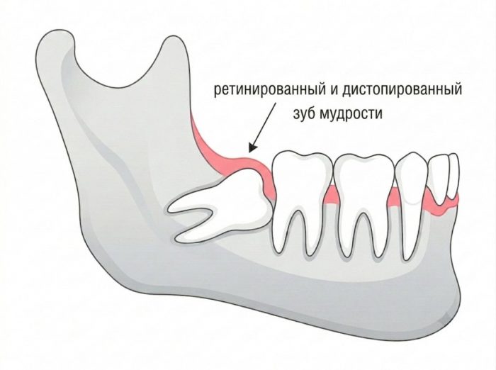 ретинированный и дистопированный зуб мудрости